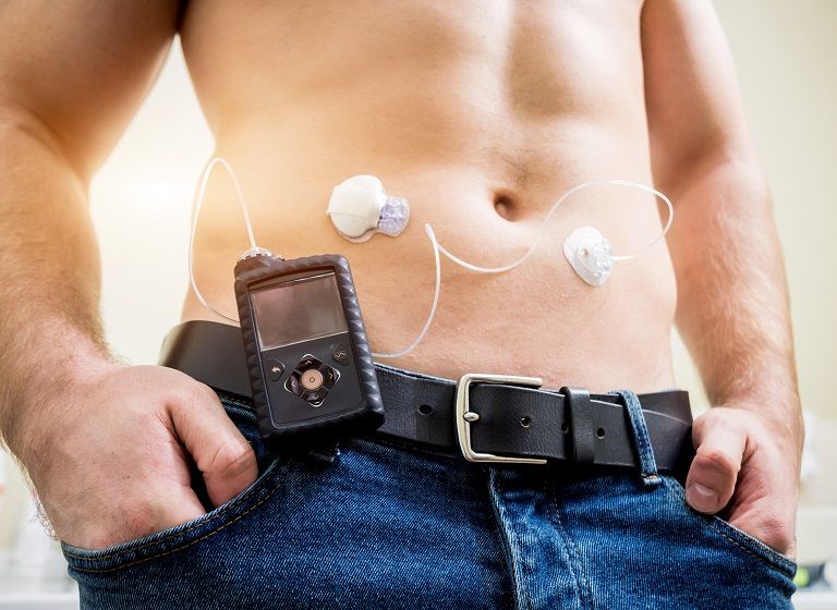 Insulin Pump Therapy